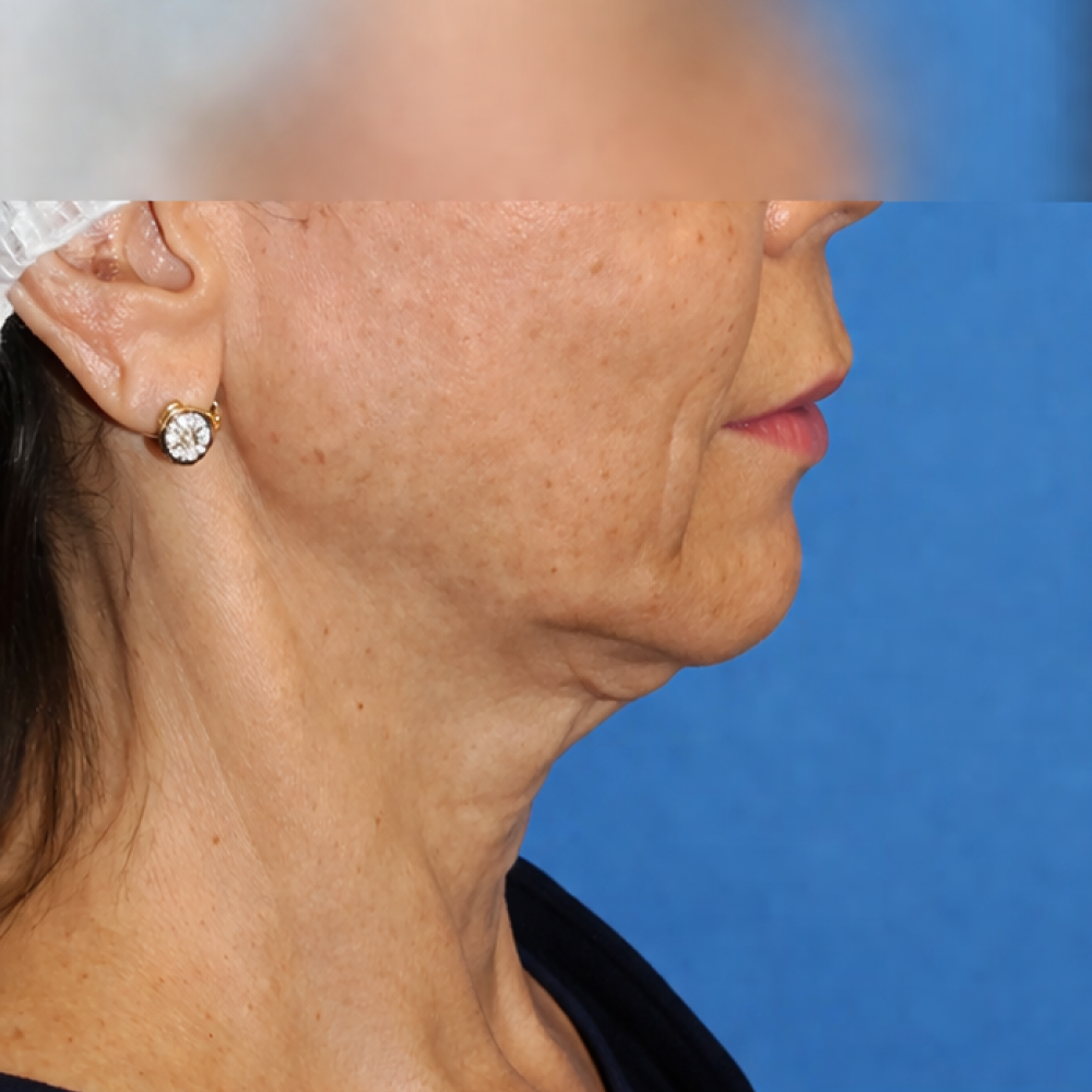 Before/After Image